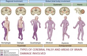 Τύποι Εγκεφαλικής Παράλυσης